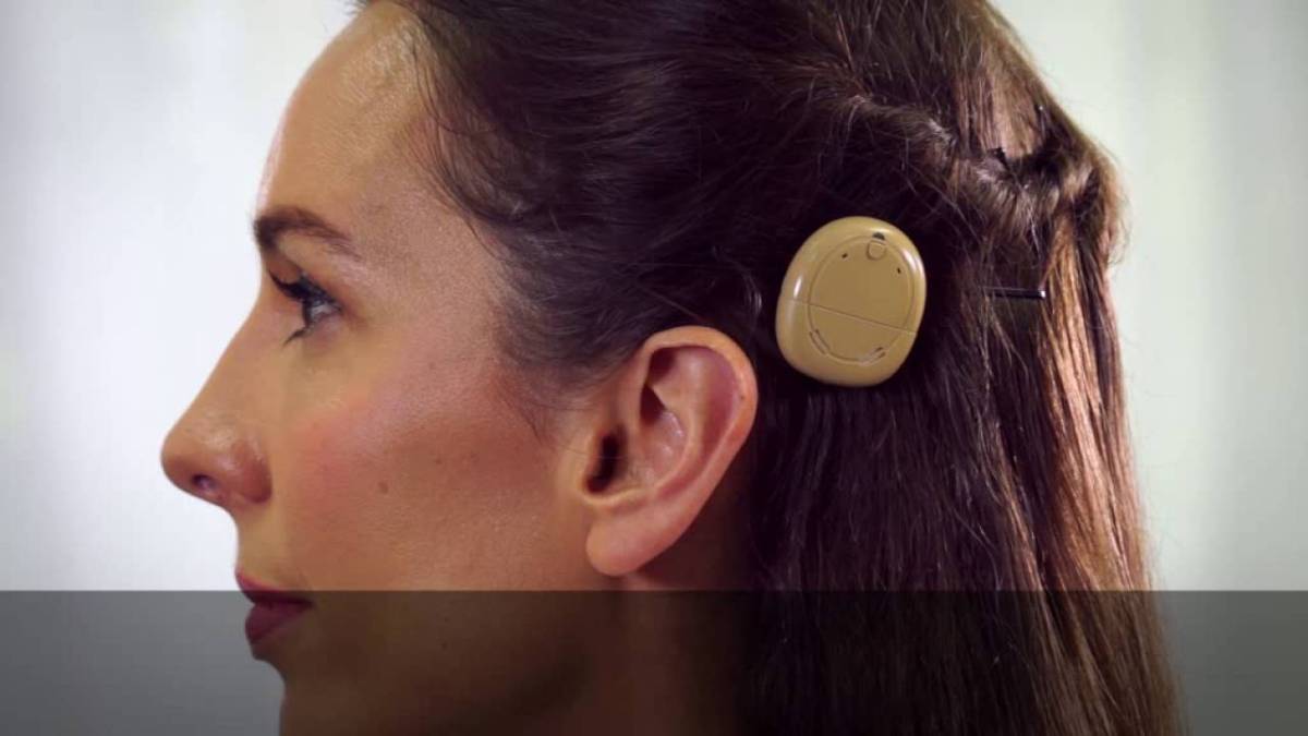 New Cochlear Devices on the&nbsp;Market